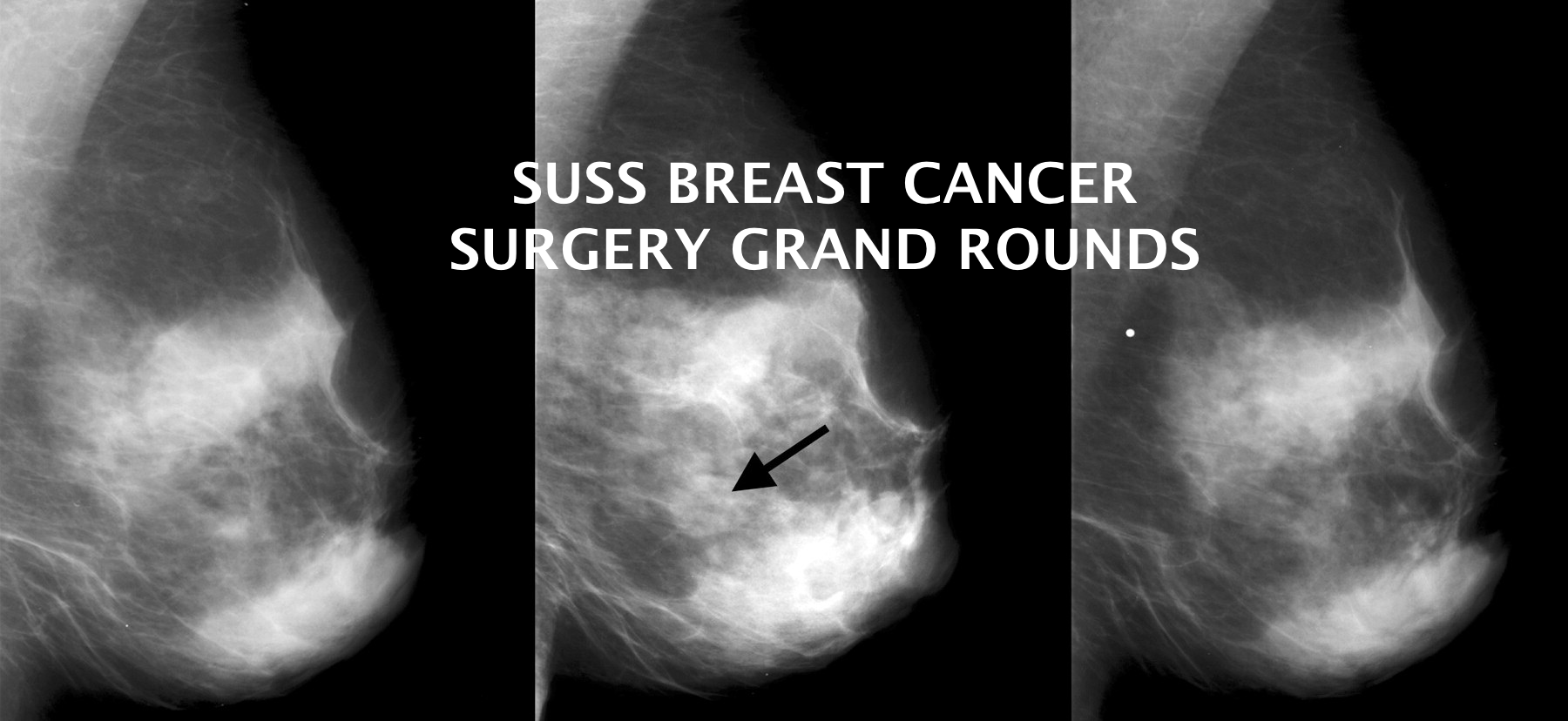 Breast Cancer Surgery Grand Rounds