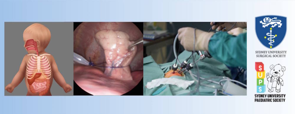 SUSS and SUPS logos and images of paediatric thoracoscopic surgery