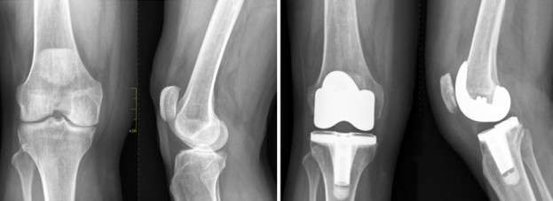 A plain radiograph of a knee joint before and after joint replacement surgery