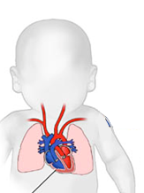 Simple silhouette of a baby with a heart, lungs, and major vessels drawn on top