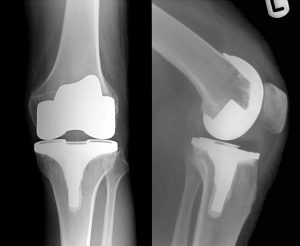 Knee replacement X-ray